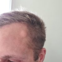 Cyst before scaled