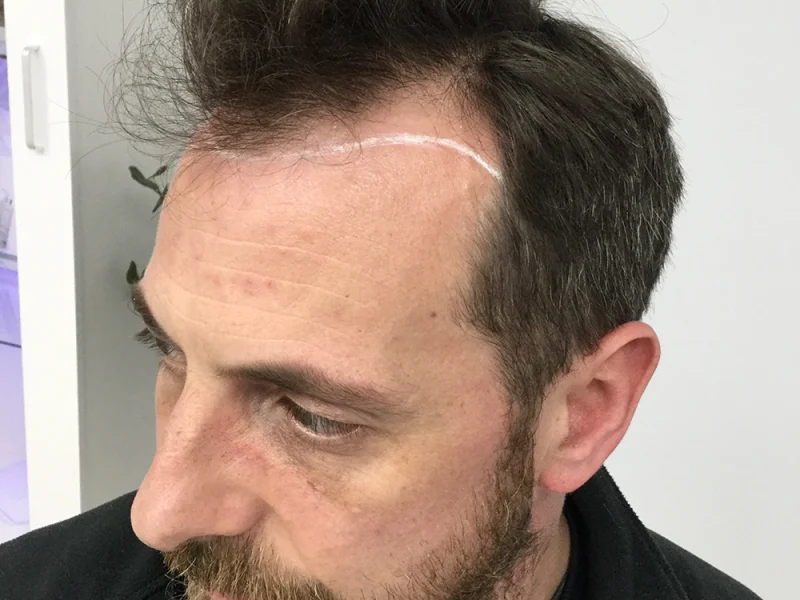 Hairline-Transplant-Journey-2