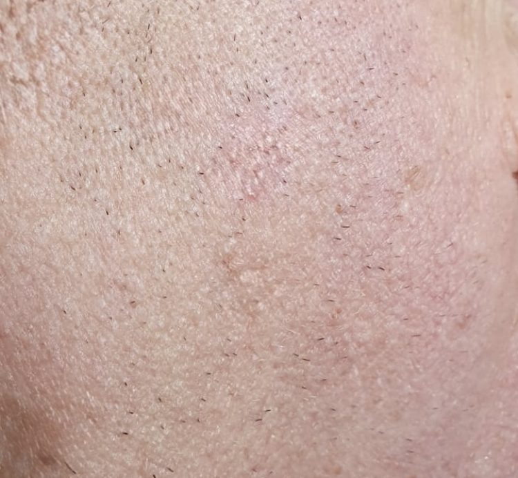 after mole removal