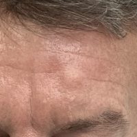 A cyst closer look