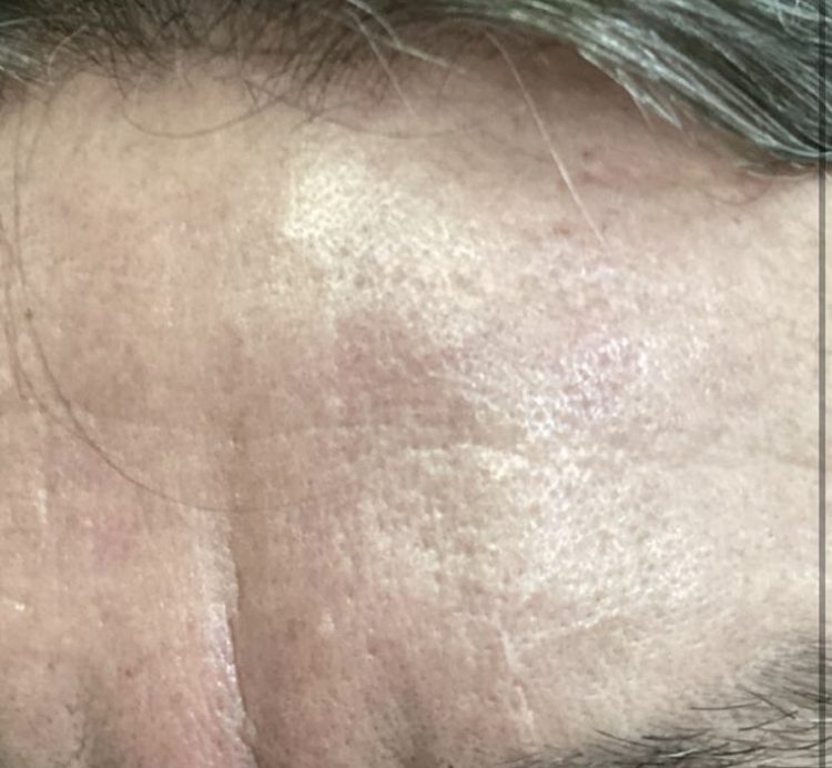 A cyst in forehead