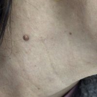 Before mole removal