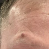 before mole removal