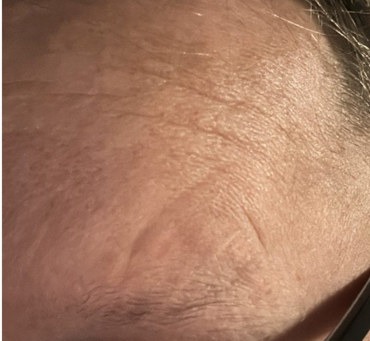 After mole removal
