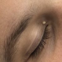 before eyelid cyst removal