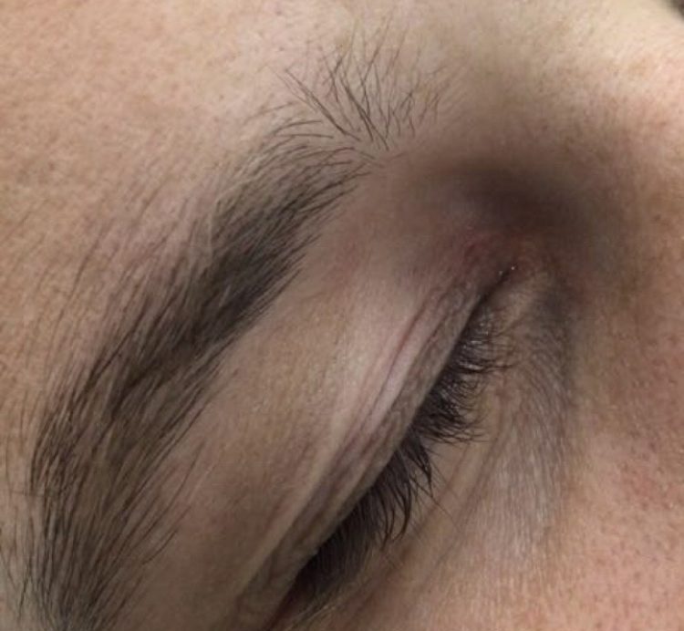 eyelid cyst removal