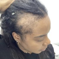 Non-Surgical Hair Treatment Before