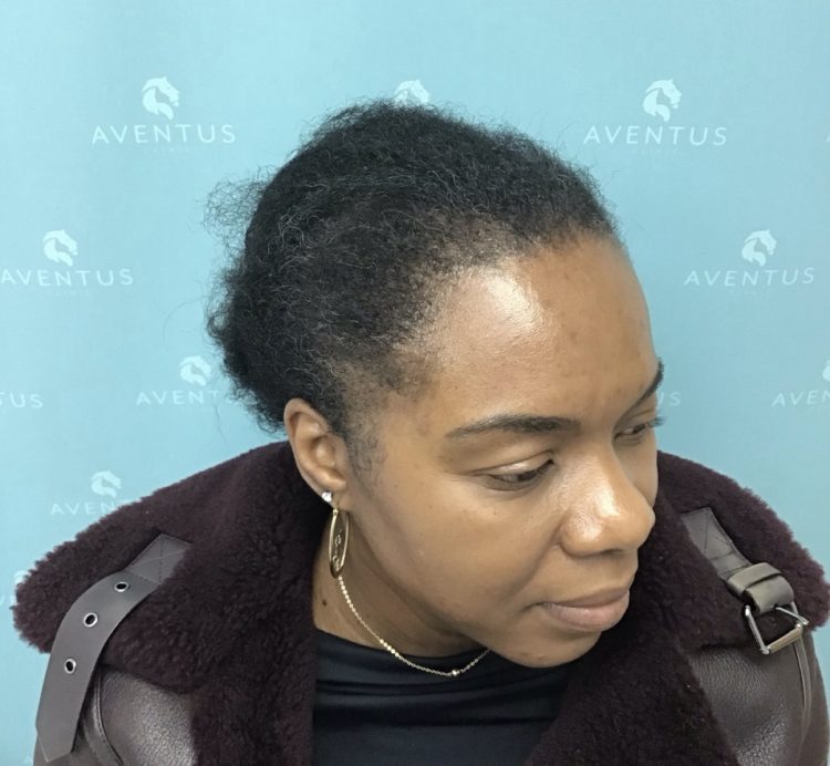 Non-Surgical Hair Treatment After
