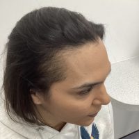 Non-Surgical Hair Treatment Before