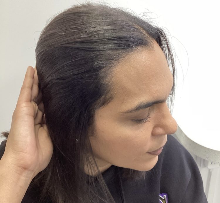 Non-Surgical Hair Treatment After