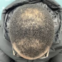 before non surgical hair treatment