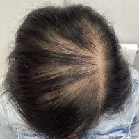 before non surgical hair treatment