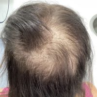 before non surgical hair treatment