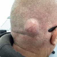 Lump-Surgery-Before