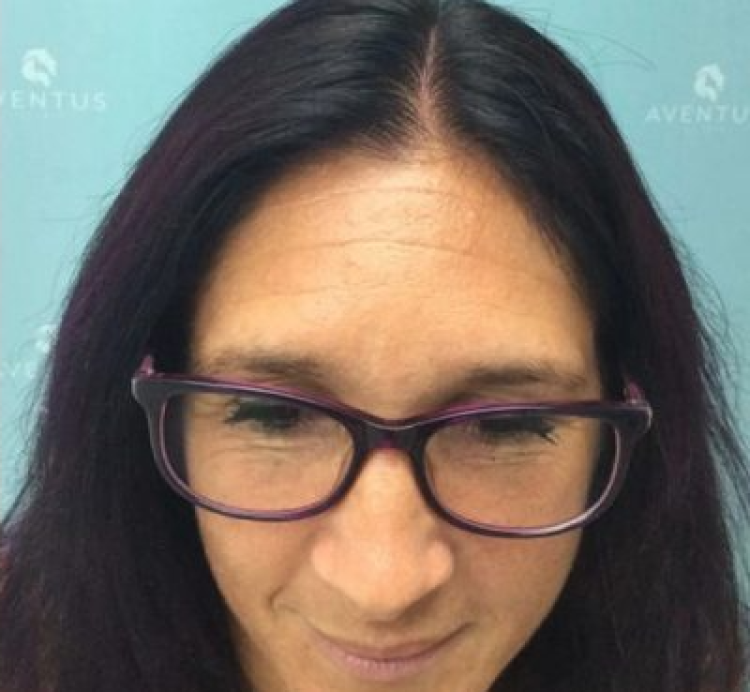 Non-Surgical Hair Treatment After
