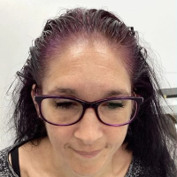 Non-Surgical Hair Treatment Before