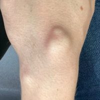 a cyst closer look