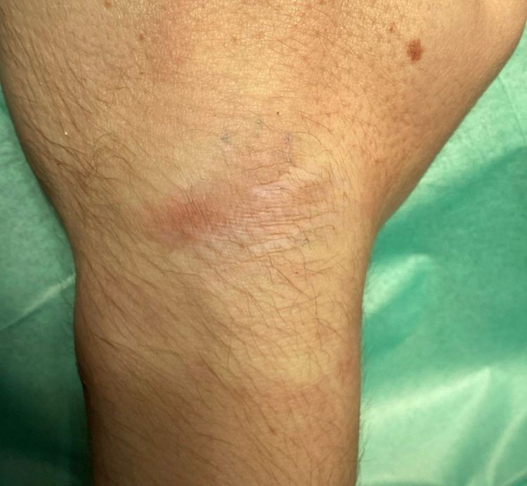 Ganglion cyst
