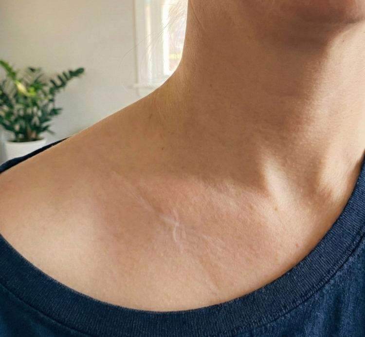 after keloid removal