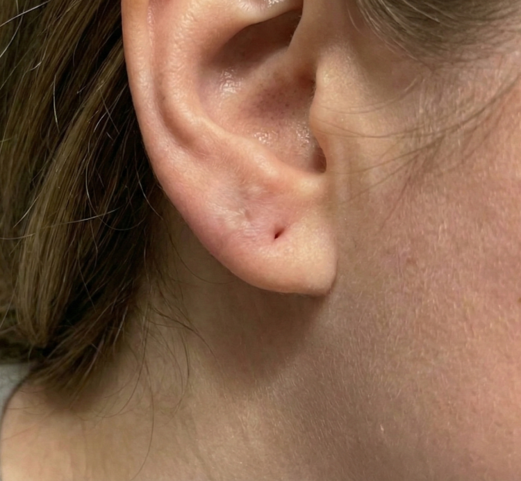 after keloid removal