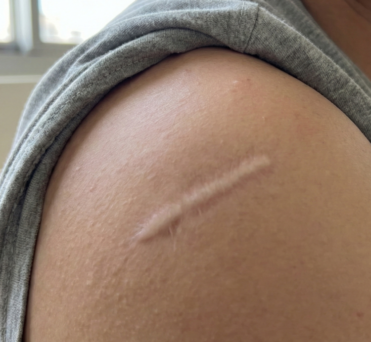 after keloid removal