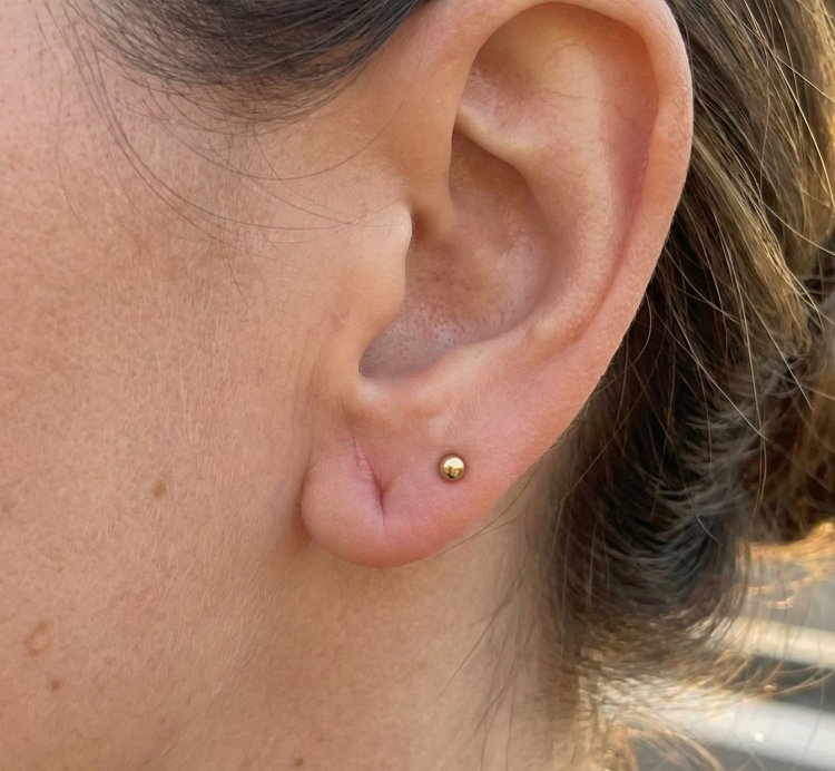 after treatment split ear lobe