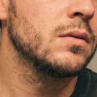 before beard transplant