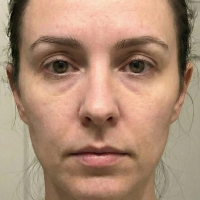 before eyebrow transplant