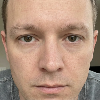 before eyebrow transplant