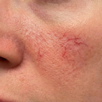 before facial veins