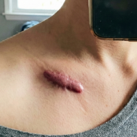 before keloid removal