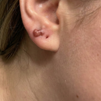 before keloid removal