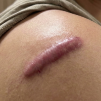 before keloid removal