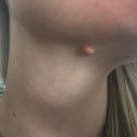A cyst on neck