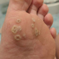 warts before