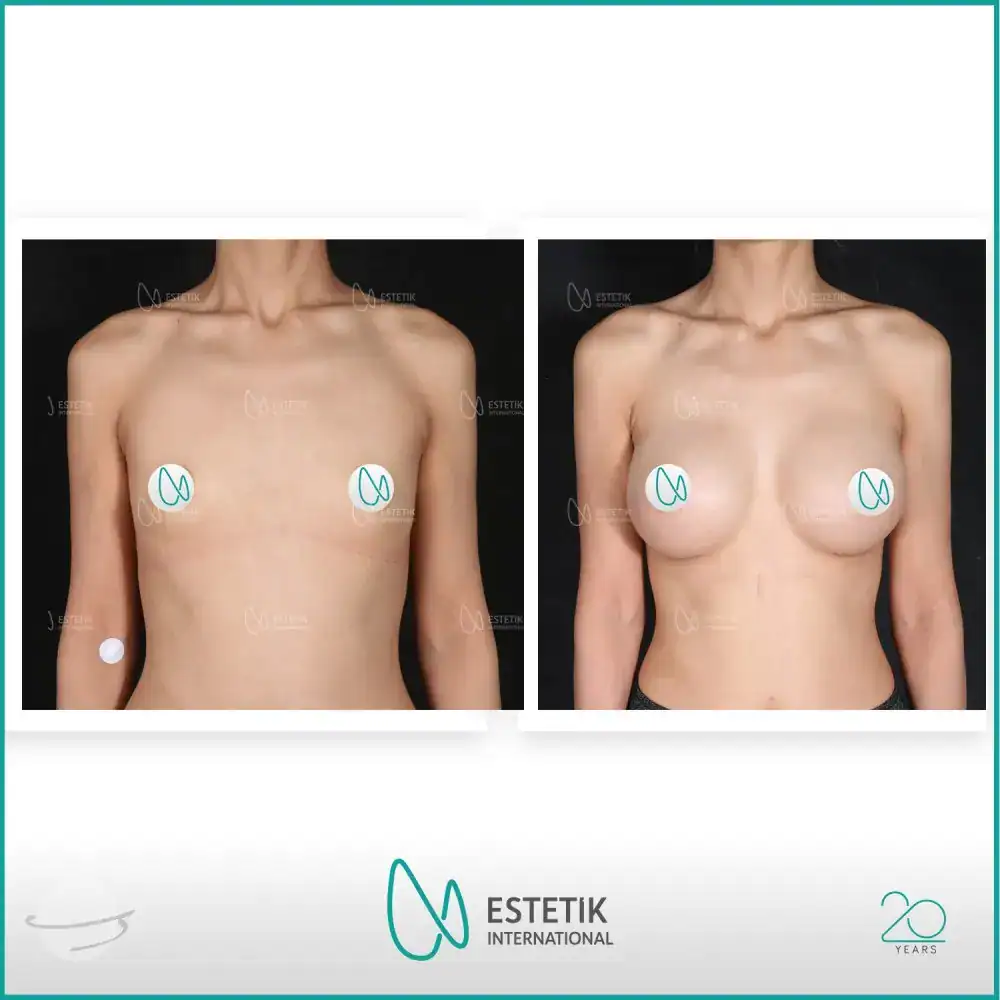 Avant et après une augmentation mammaire réalisée à la clinique Estetik International en Turquie