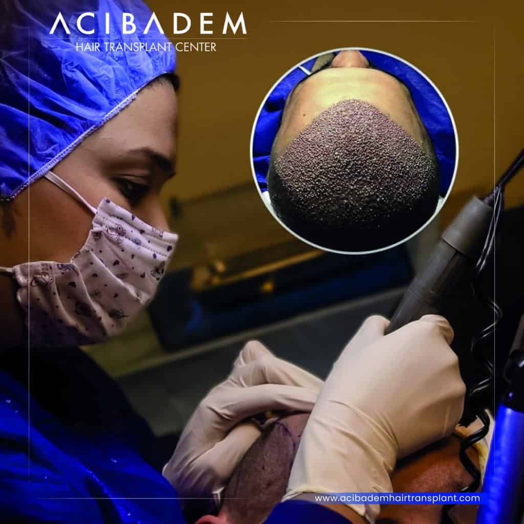 Intervento di trapianto di capelli FUE presso Acibadem Hair Transplant Center con chirurgo specializzato