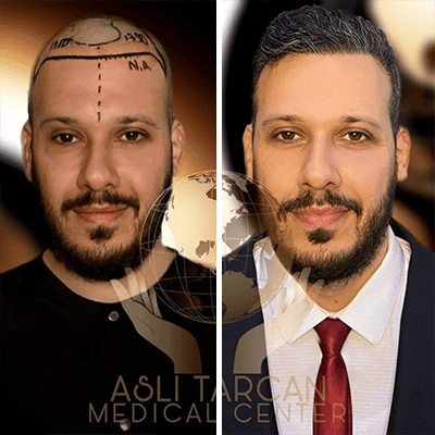 Avant et après greffe capillaire et de barbe à la clinique Aslı Tarcan en Turquie