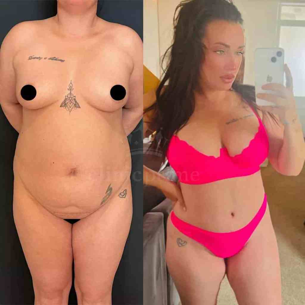Risultato prima e dopo addominoplastica e liposuzione per rimodellamento del corpo e pancia piatta