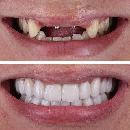 Risultato Hollywood Smile prima e dopo il trattamento con impianti dentali All-on-4