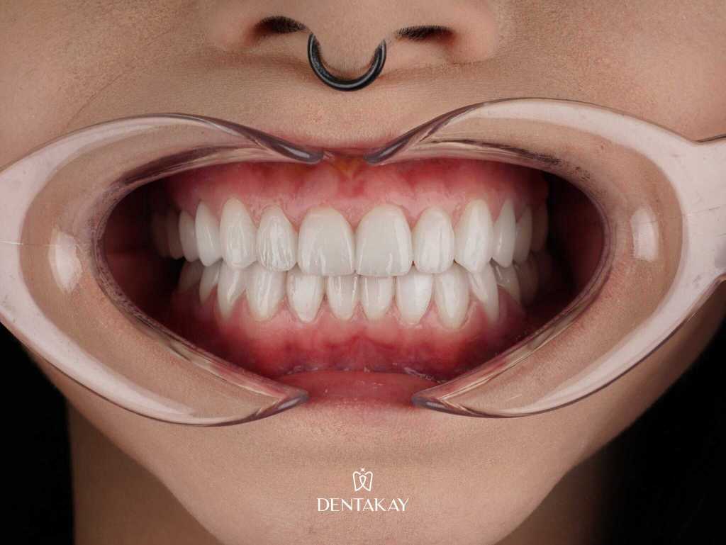 Faccette dentali prima e dopo il trattamento estetico presso la clinica Dentakay