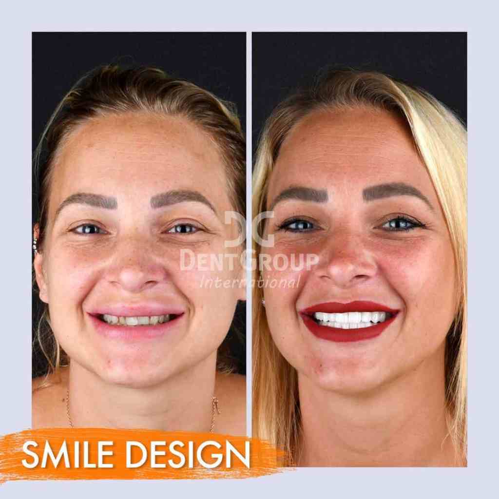 Risultato prima e dopo Digital Smile Design (DSD) con faccette dentali e corone presso DentGroup International