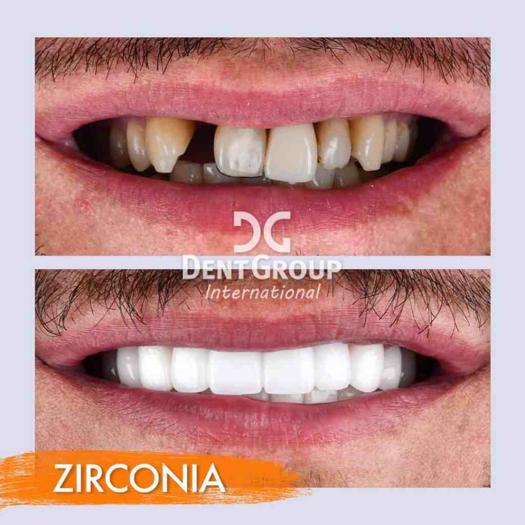 Risultato prima e dopo l'applicazione di un ponte dentale in zirconia presso DentGroup International