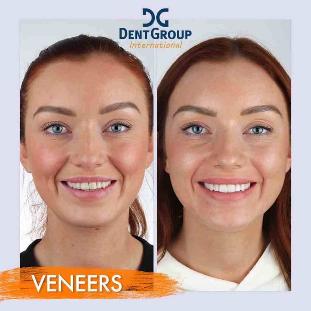 Trasformazione estetica del sorriso con faccette dentali (veneers) prima e dopo il trattamento in clinica