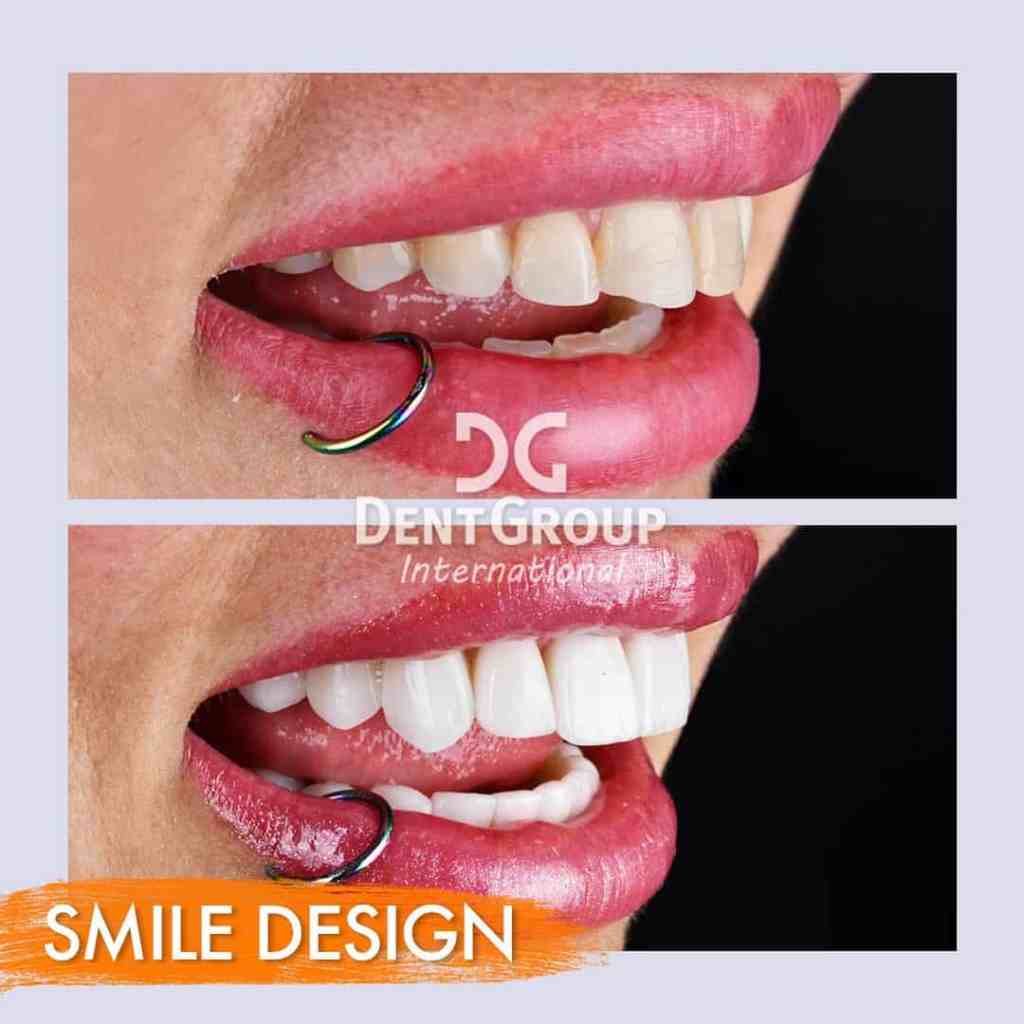 Dettaglio Smile Design: confronto prima e dopo l'applicazione di faccette dentali e corone in zirconia