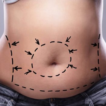 Préparation à une intervention de liposuccion à la clinique EsteCapelli Istanbul Illustration du ventre avec marquages chirurgicaux avant liposuccion à la clinique EsteCapelli