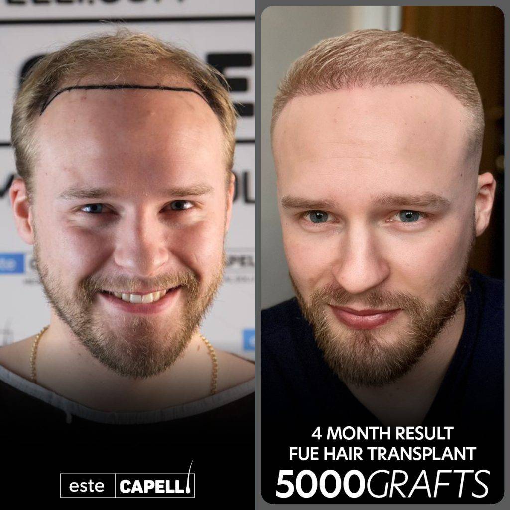 Greffe capillaire FUE – résultat à 4 mois à la clinique EsteCapelli Istanbul Résultat avant et après greffe de cheveux FUE à la clinique EsteCapelli, 4 mois après l’intervention