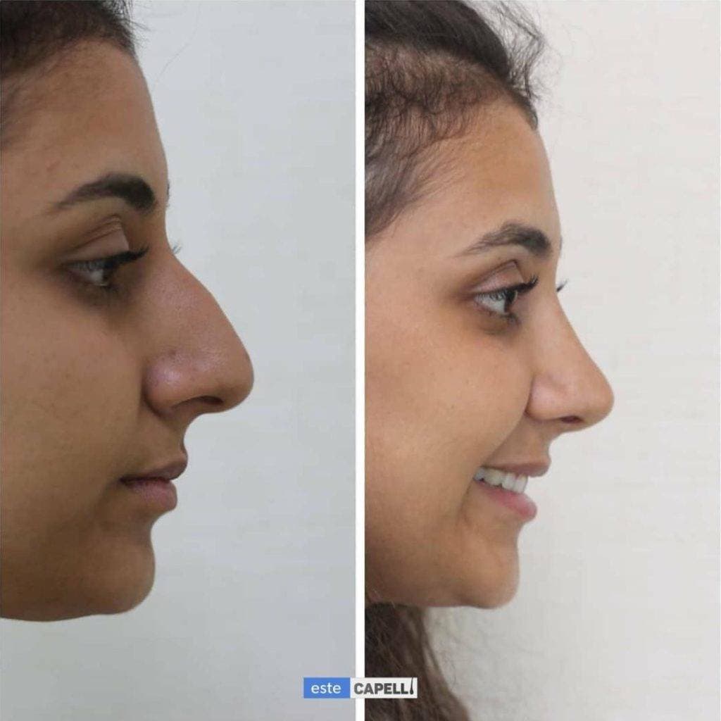 Rhinoplastie avant et après à la clinique EsteCapelli Istanbul Résultat avant et après rhinoplastie à la clinique EsteCapelli montrant la correction du profil nasal