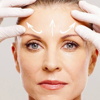 Lifting du visage et techniques esthétiques avancées à la clinique EsteCapelli Istanbul Femme préparée pour un lifting du visage avec flèches indiquant les zones de rajeunissement esthétique