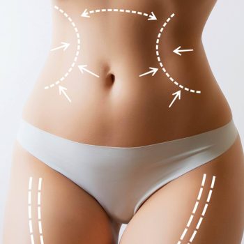 Liposuccion Vaser et remodelage de la silhouette – EsteCapelli Istanbul Schéma sur le corps féminin illustrant les zones de liposuccion et de remodelage corporel à la clinique EsteCapelli